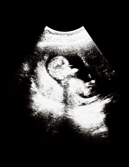 Smiths History 1958 Early Ultrasound Image